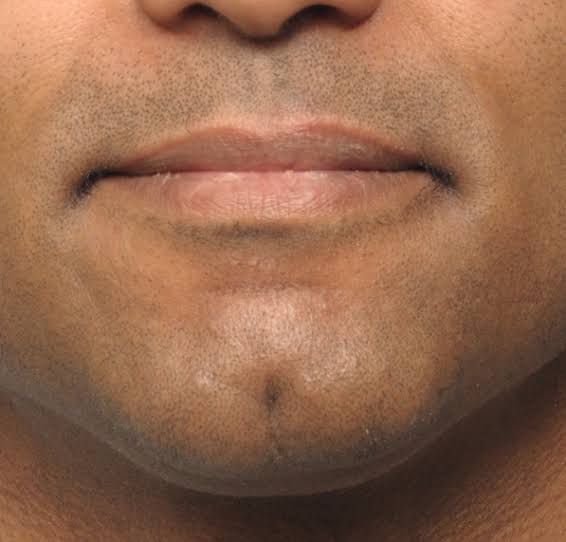Chin dimple in Riyadh (10).jpg