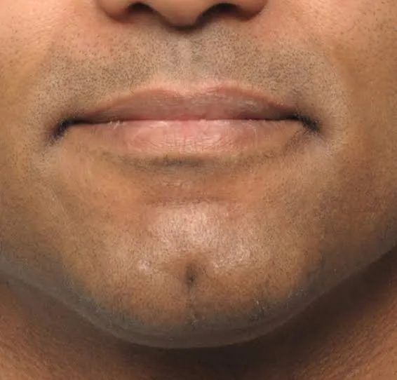 How to Treat a Chin Dimple in Riyadh for a More Balanced Facial Look