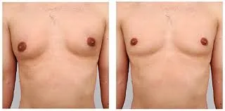 Expert Insights on Gynecomastia Surgery in Riyadh and Modern Treatment